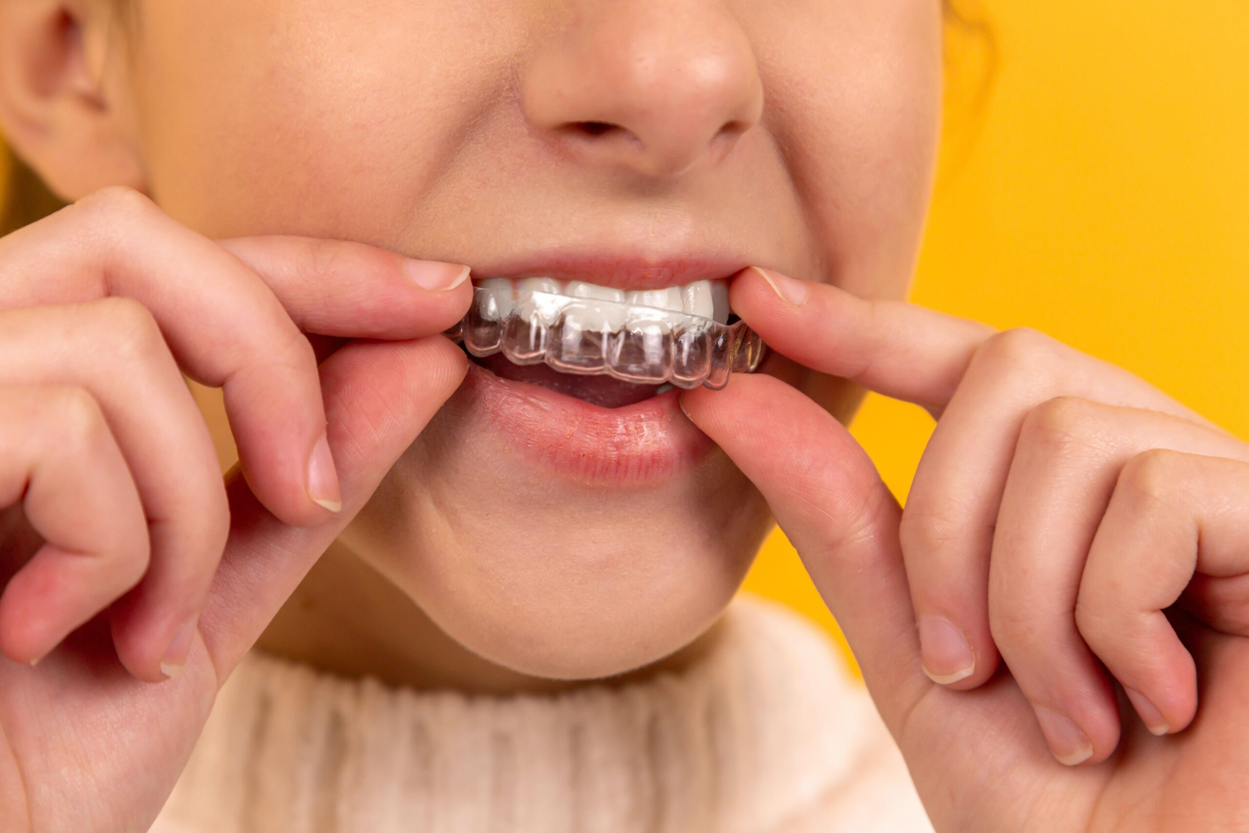Everything You Need To Know About SmileDirectClub