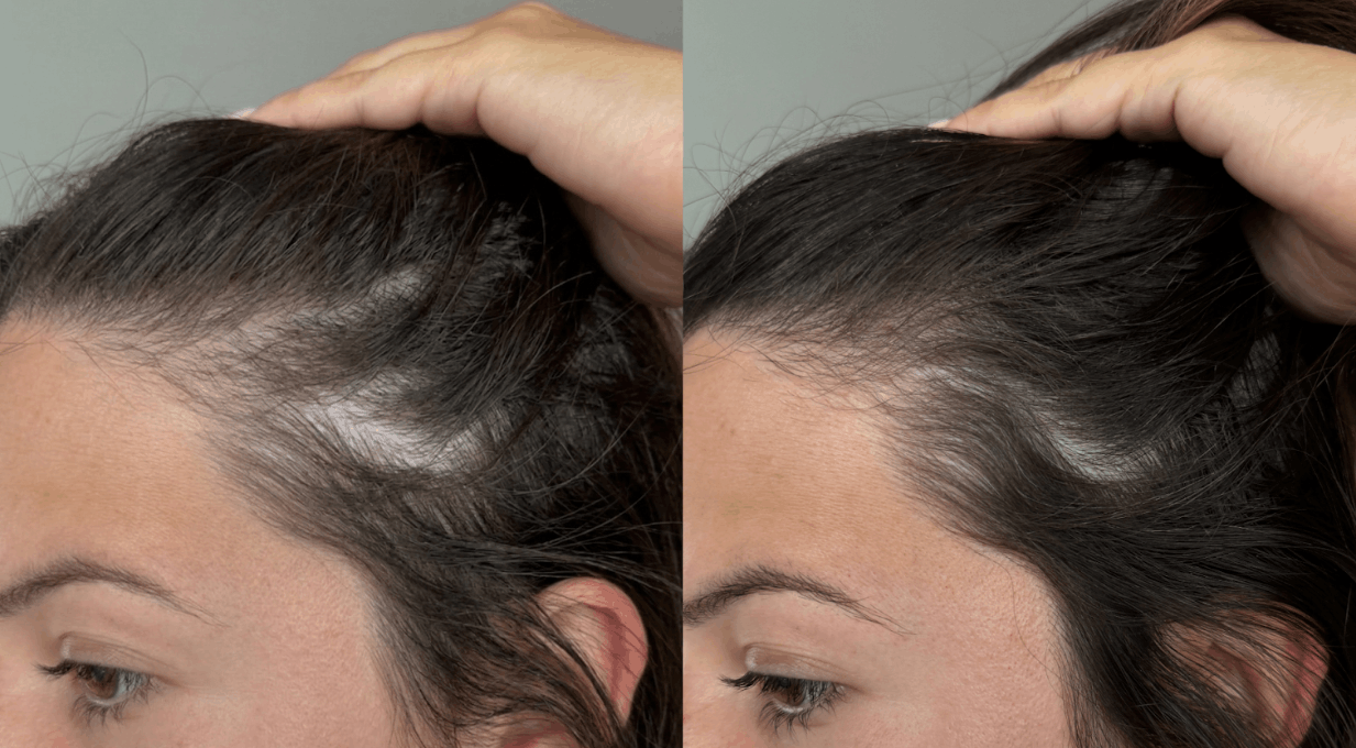 Why I Use Dermatologist-Developed KilgourMD For My Thinning Hair
